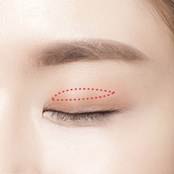 눈매교정 수술방법 2