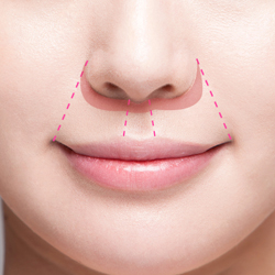 입술거상 수술방법 2